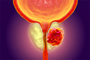 Эффективное лечение (удаление) аденомы простаты у мужчин